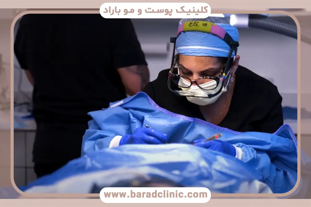 کاندیدای مناسب کاشت ریش به روش میکروگرافت