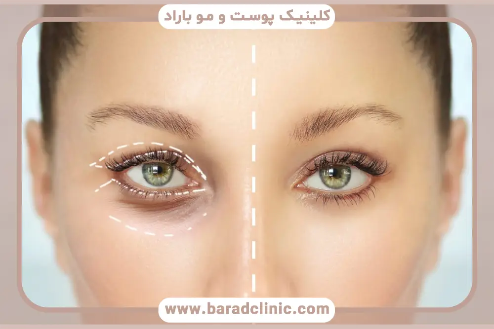 تفاوت بلفاروپلاستی درمانی و زیبایی