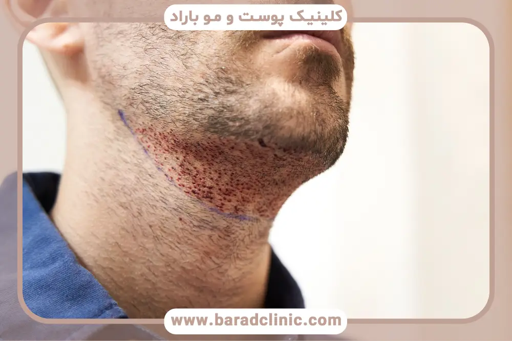 بررسی کاشت ریش برای افراد کوسه