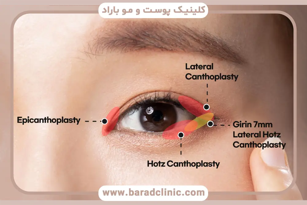 مهم‌ترین فرق کانتوپلاستی و بلفاروپلاستی 