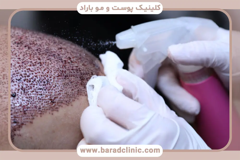 تخصص جراح در تعیین قیمت کاشت مو در تهران 