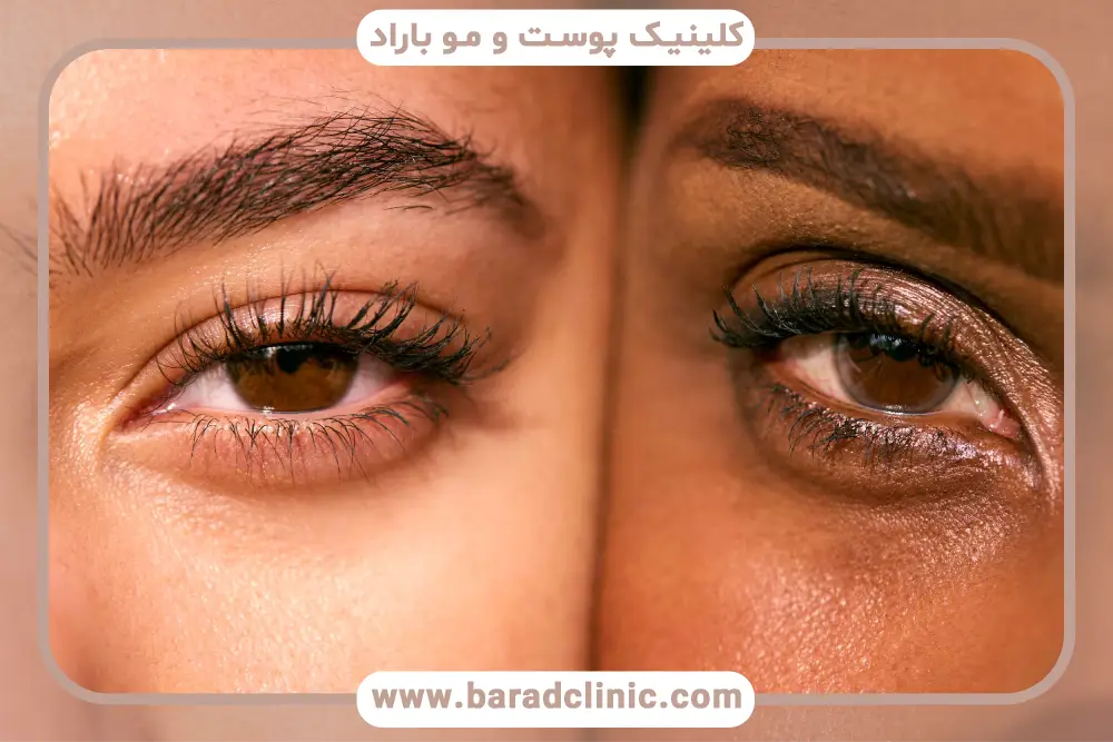 انواع بلفاروپلاستی جراحی پلک گربه ای