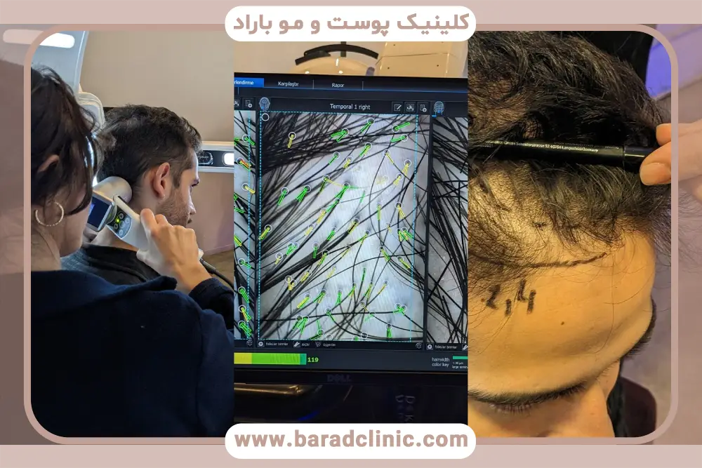 آیا بیماران مبتلا به هپاتیت می توانند کاشت مو انجام دهند