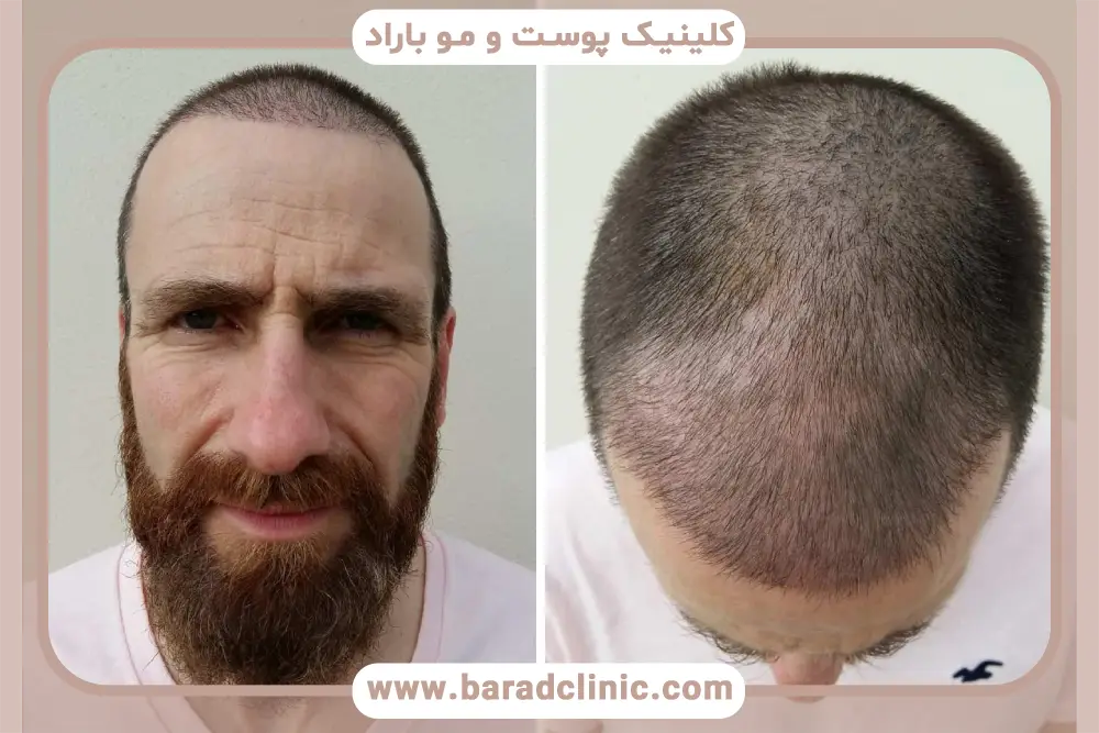 مراحل کاشت مو به روش fit 