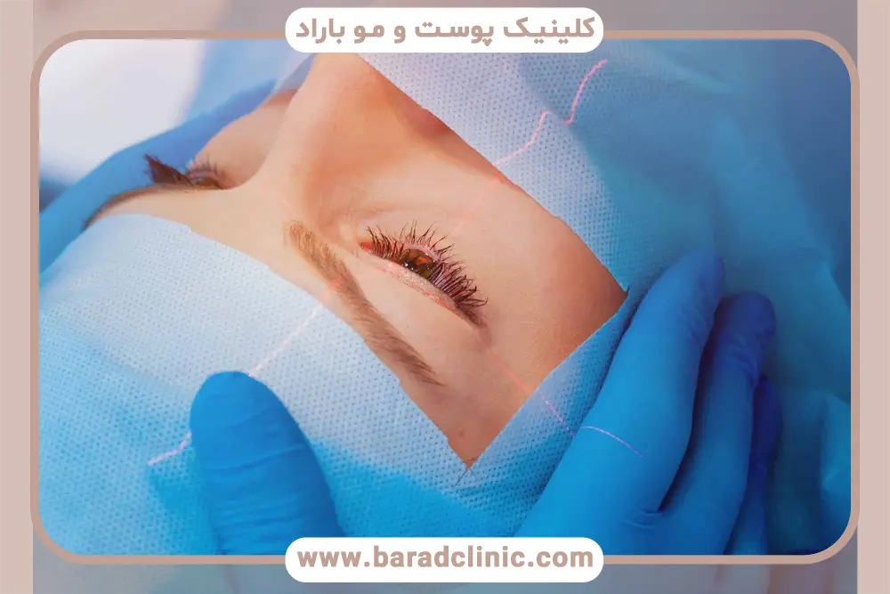 انواع بلفاروپلاستی صورت چیست