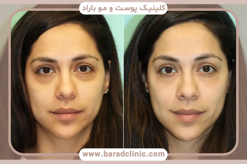 دلایل نیاز به بلفاروپلاستی گودی زیر چشم 