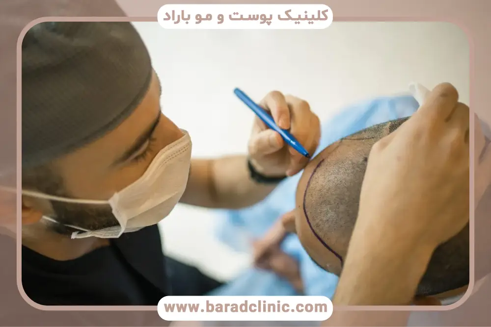 نتیجه کاشت مو بعد از سه ماه و وضعیت موهای جدید