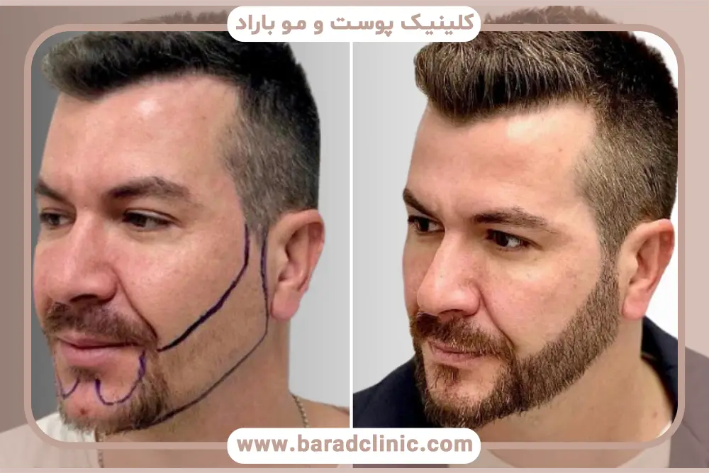 مراحل کاشت ریش در جای بخیه