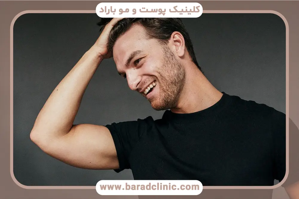 کاشت ریش در جای زخم با تراکم بالا 