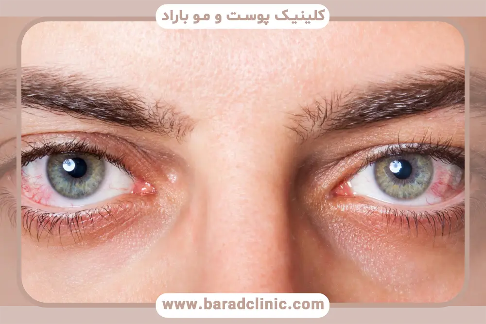 دلایل خشکی چشم بعد از بلفاروپلاستی 