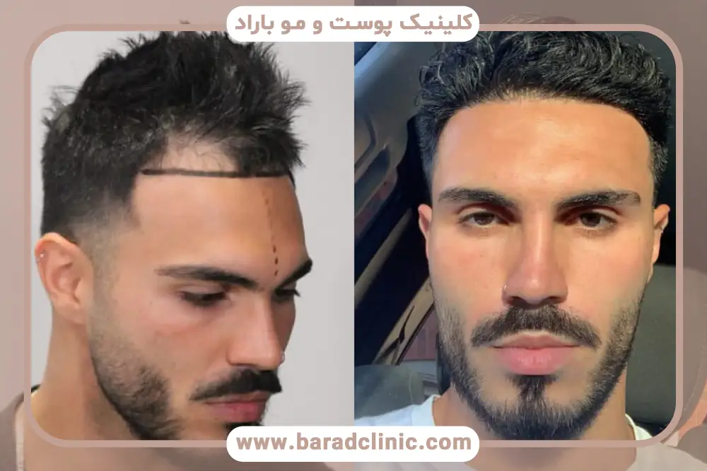 روش کاشت مو FUT