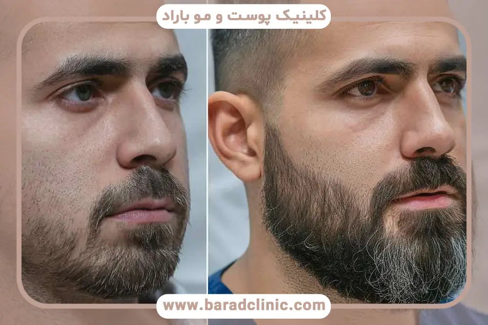 کاندیدای مناسب کاشت ریش روی چانه 