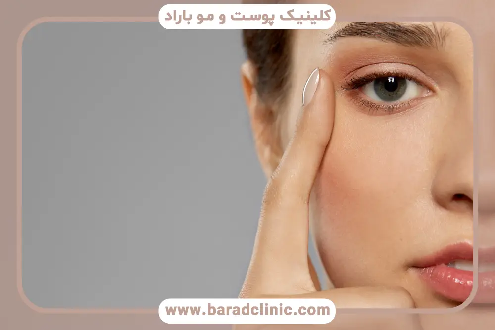 زمان کشیدن بخیه بلفاروپلاستی