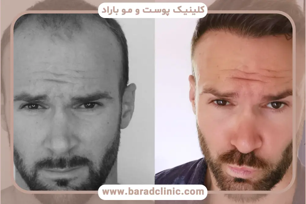 دلایل بررسی عکس کاشت مو بعد از سه ماه 