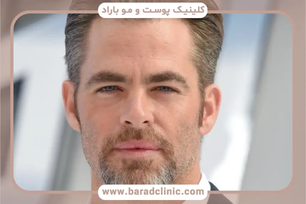 ویژگی‌های ظاهری کاشت ریش پروفسوری 