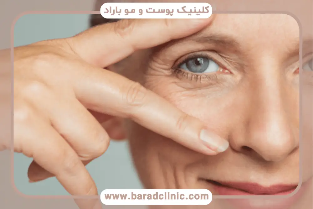 دلایل چسبندگی پلک بعد از بلفاروپلاستی