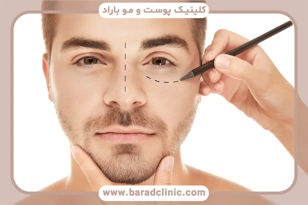 اهمیت زمان ورزش بعد از بلفاروپلاستی 