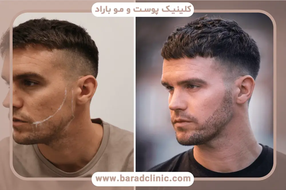 عوامل موثر بر هزینه کاشت خط ریش 