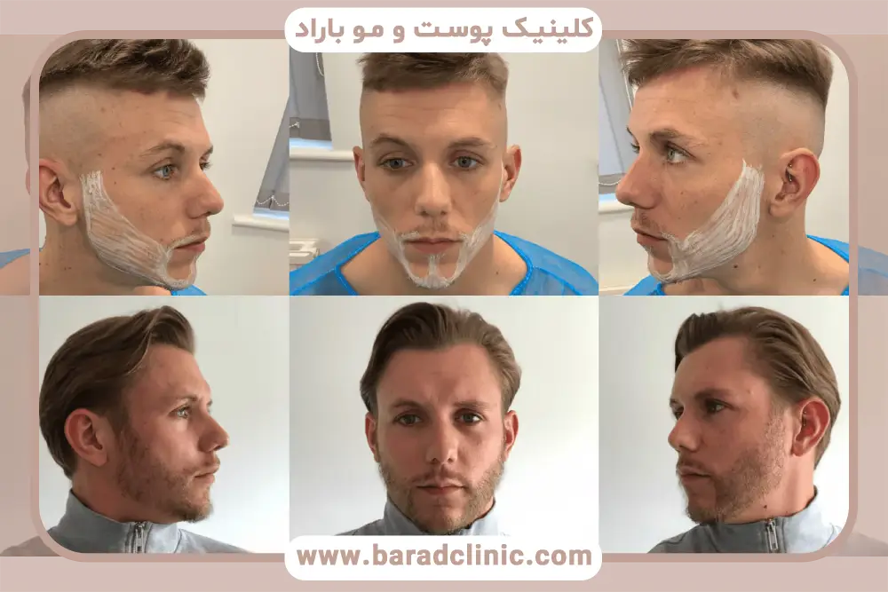 مراحل کاشت در فیلم کاشت ریش