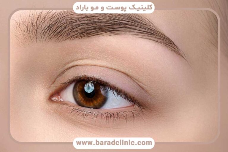 کاشت ابرو بعد از چند ماه طبیعی می‌شود؟