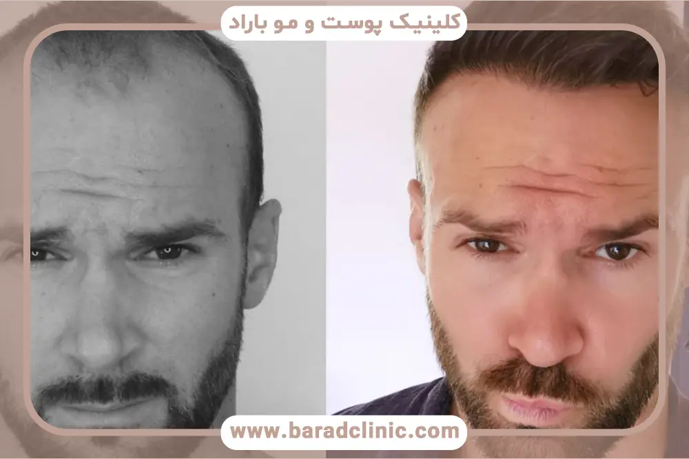 میکروگرافت بهترین روش کاشت مو با تراکم بالا 