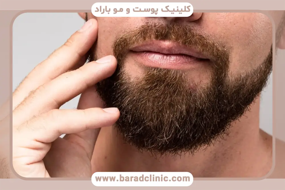 بانک موی مناسب در کاشت ریش