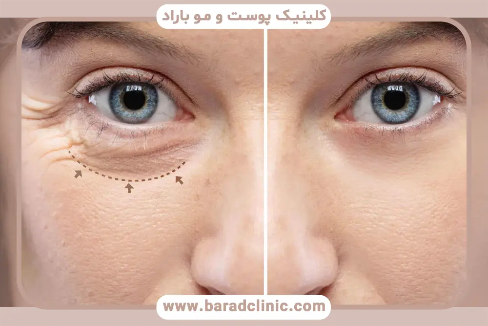 تاثیر تجربه جراح روی خط بخیه بلفاروپلاستی