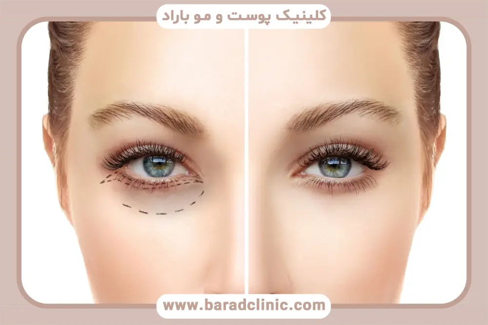 خدمات مشاوره بلفاروپلاستی در تهران