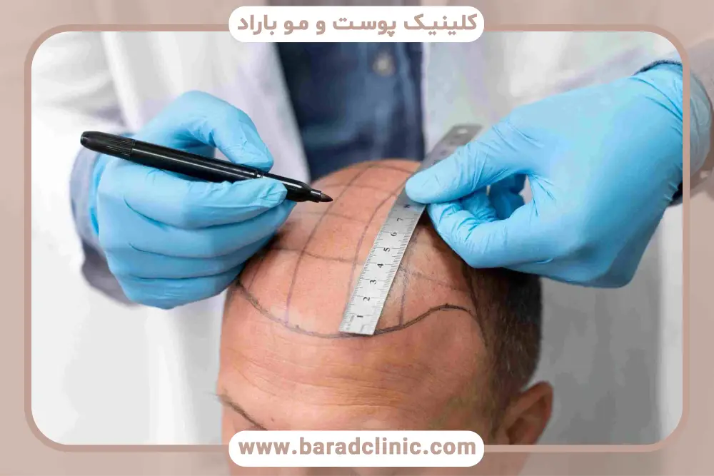 روش‌های کاشت مو در مرکز کاشت مو تهران