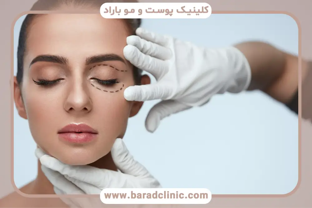 مزایای بلفاروپلاستی درمانی