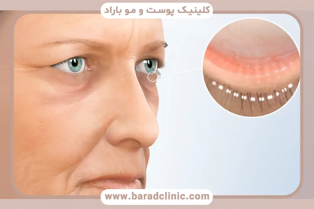 مراحل بلفاروپلاستی سرپایی 