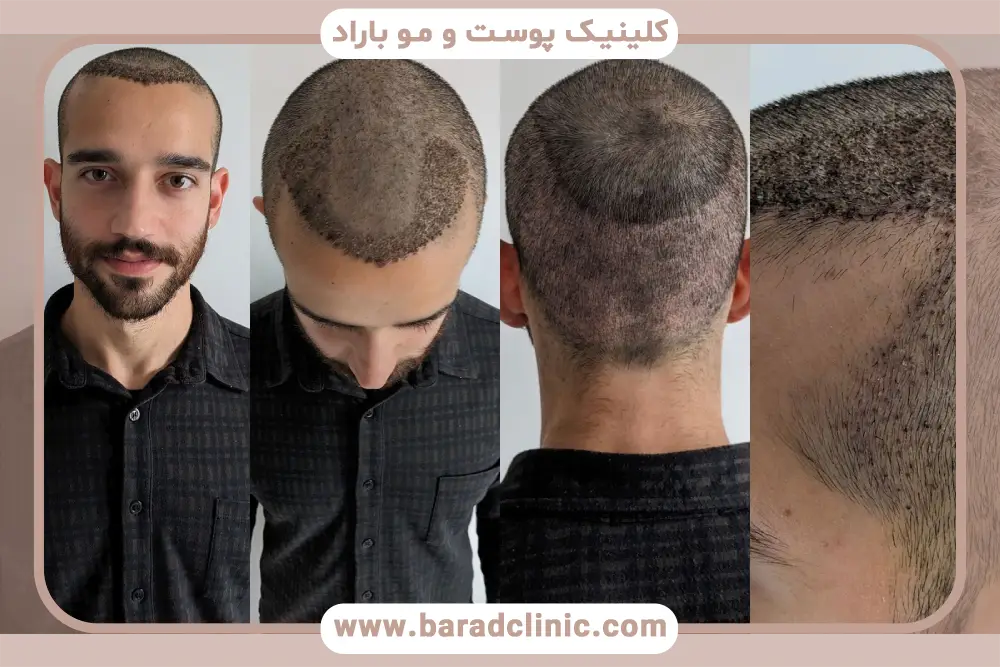 تاثیر عکس کاشت مو روی اعتماد مراجع