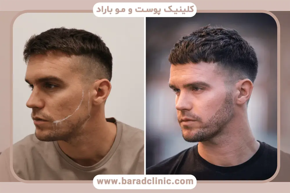 بررسی ماندگاری با تصاویر قبل و بعد کاشت ریش 