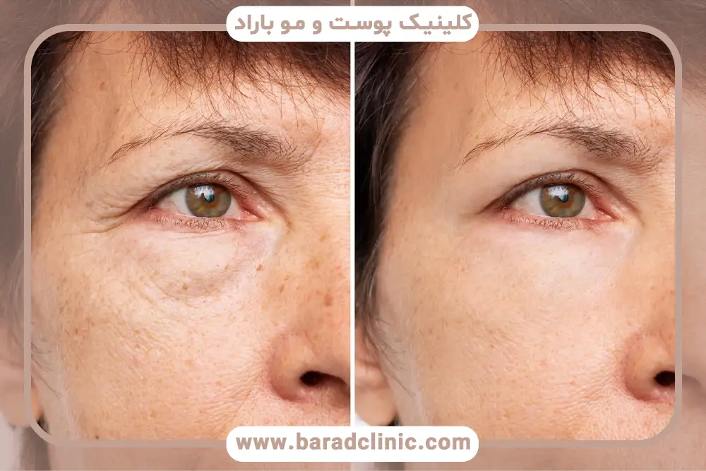 تغذیه در بلفاروپلاستی روز اول 