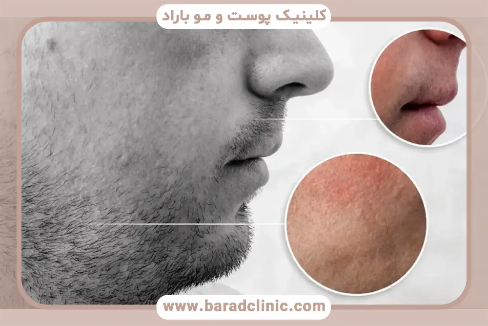 بررسی تصاویر کاشت ریش و سبیل قبل و بعد