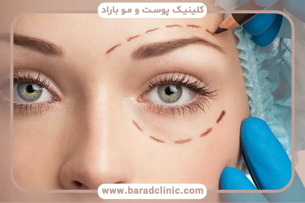 اهداف زیبایی و درمانی بلفاروپلاستی ابرو