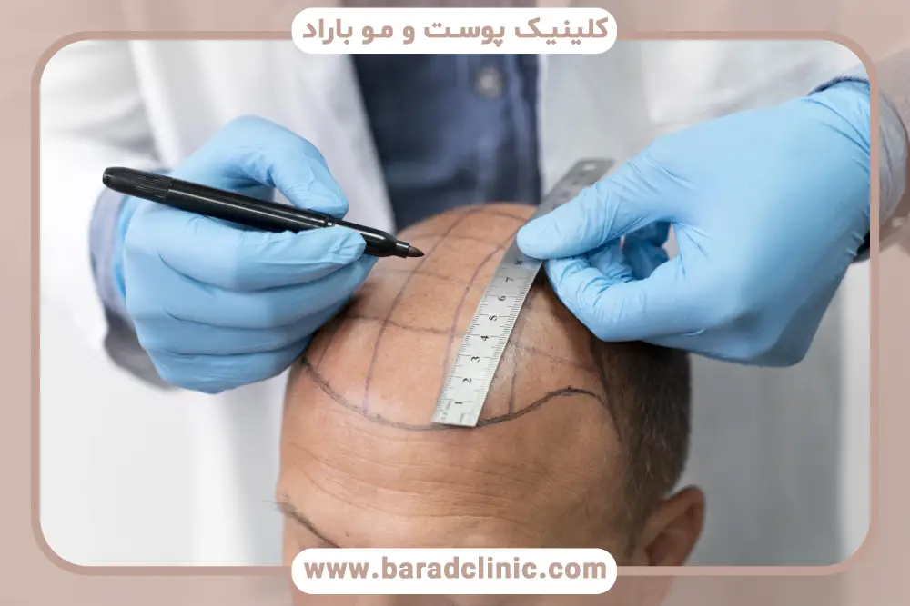 روش‌های مختلف کاشت مو 