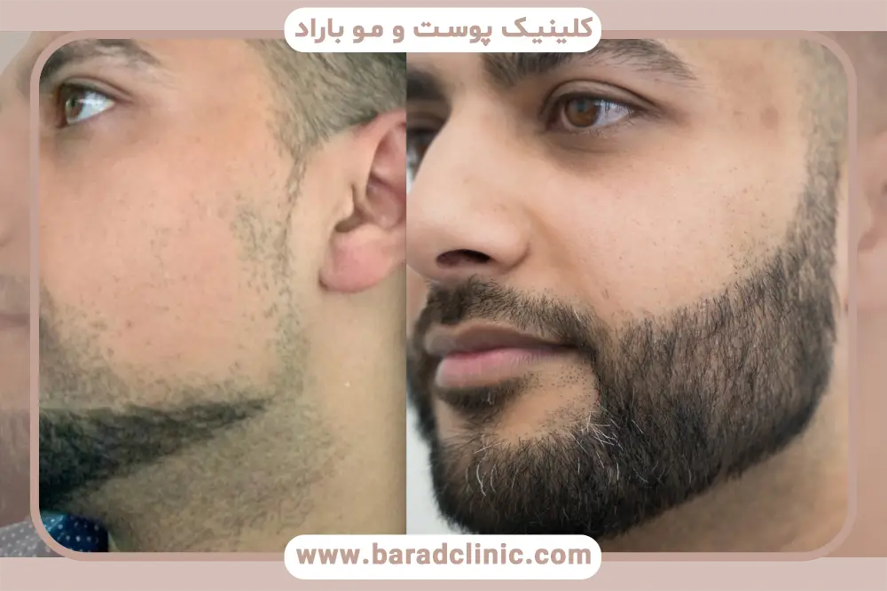 تصاویر واقعی و تبلیغاتی کاشت ریش