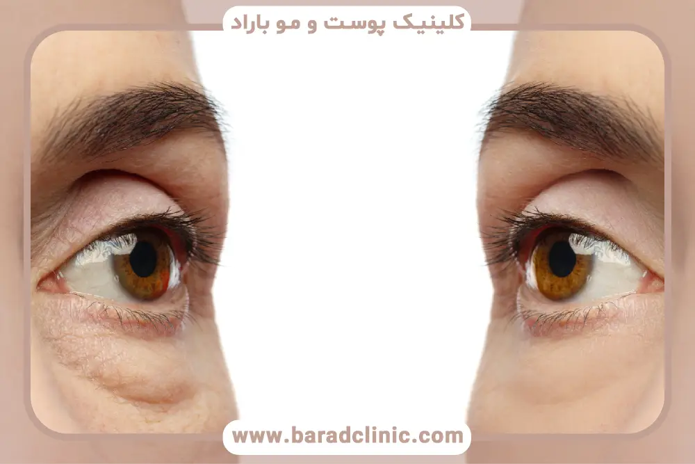 مراحل بلفاروپلاستی با لیزر