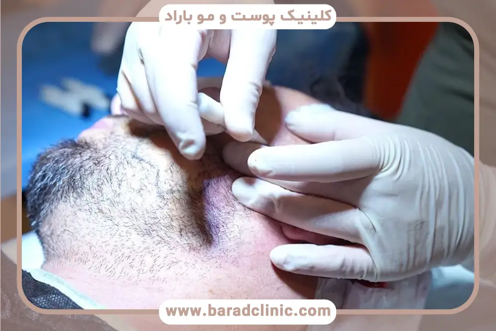 بانک مو یکی از مهم‌ترین شرایط کاشت ریش 