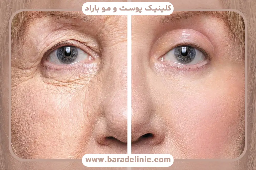 خطرات جدی بلفاروپلاستی