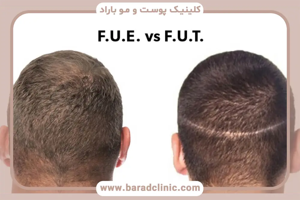تاثیر تخصص جراح روی هزینه کاشت مو fut