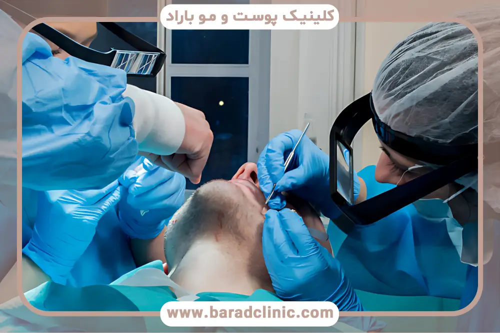 مراقبتهای قبل و بعد کاشت ریش به روش میکروگرافت