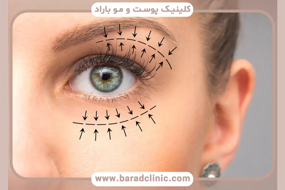 شرایط مهم بلفاروپلاستی با بیمه تکمیلی 