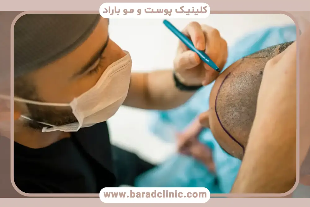 معیارهای انتخاب بهترین روش کاشت مو در دنیا 