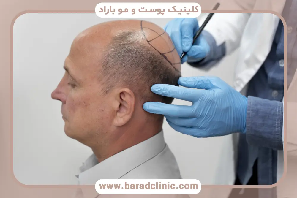 تاثیر روش کاشت روی قیمت کاشت مو در تهران 