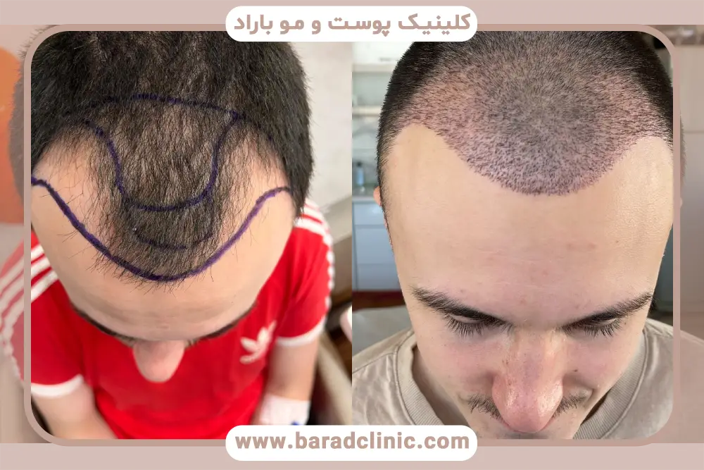 مزایای کاشت مو بدون کچل کردن