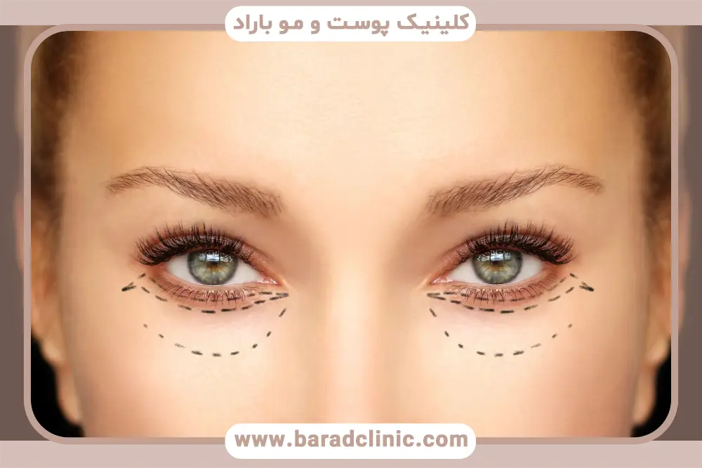 مراحل بلفاروپلاستی جراحی پلک گربه ای