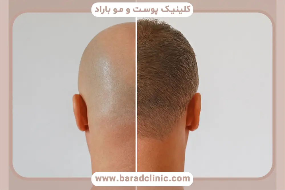 هزینه کاشت مو به روش fit 