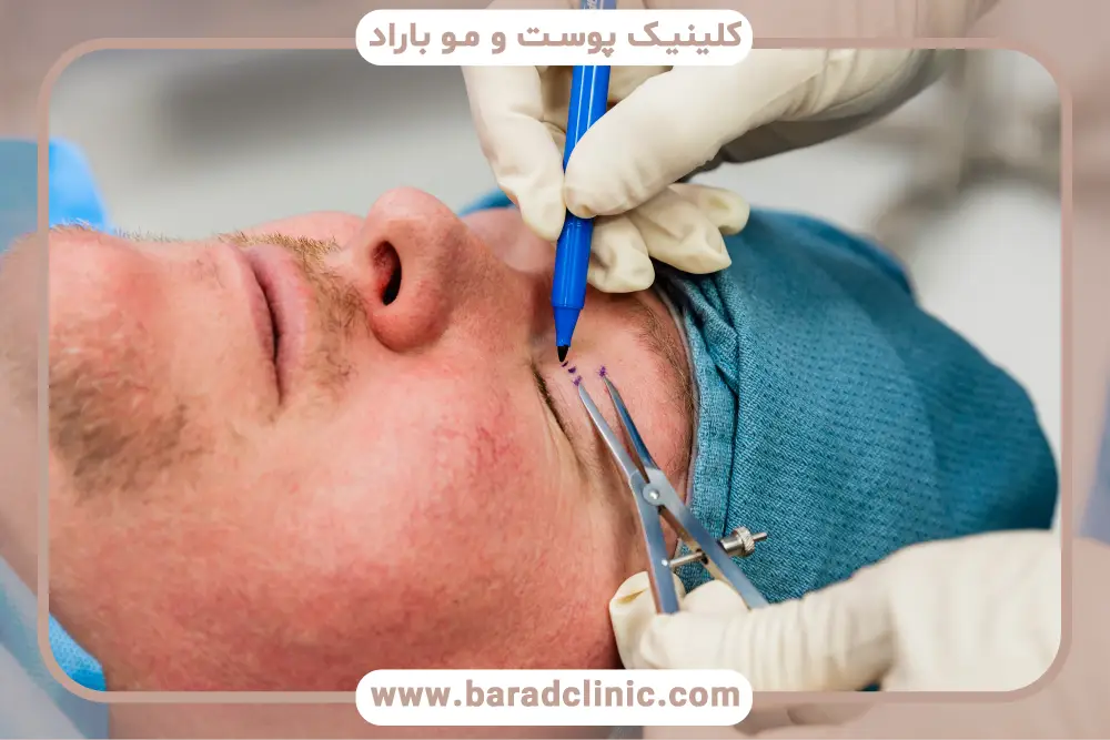 مراقبت‌های قبل و بعد بلفاروپلاستی صورت